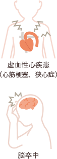 虚血性心疾患を説明する心臓を中心とした簡易なイラストと脳卒中を説明する頭部を中心とした簡易なイラストです。