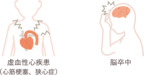 虚血性心疾患を説明する心臓を中心とした簡易なイラストと脳卒中を説明する頭部を中心とした簡易なイラストです。