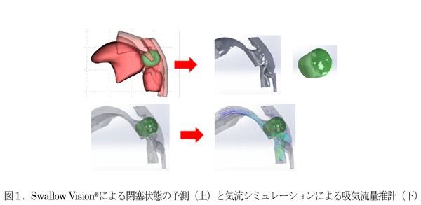 写真：図1.Swallow Vision®による閉塞状態の予測（上）と気流シミュレーションによる吸気流量推計（下）