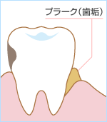 プラーク(歯垢)