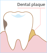 Dental plaque