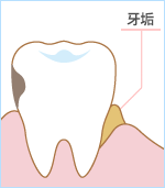 牙垢